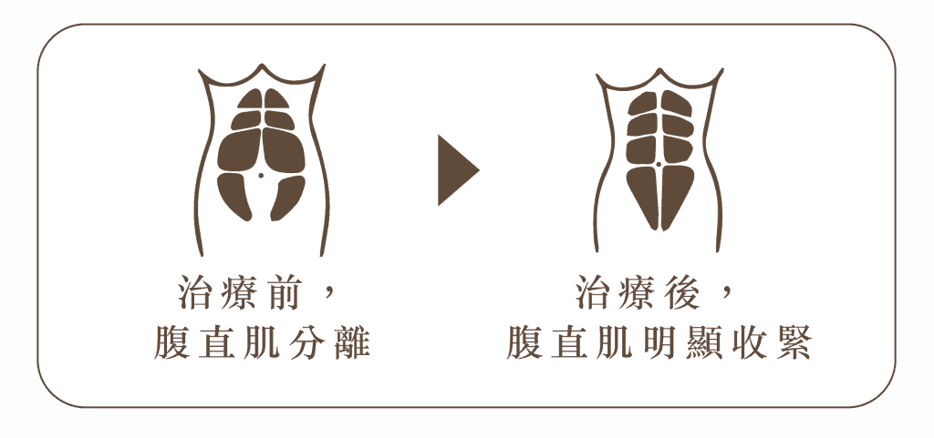 紮肚及產後修復療程優惠