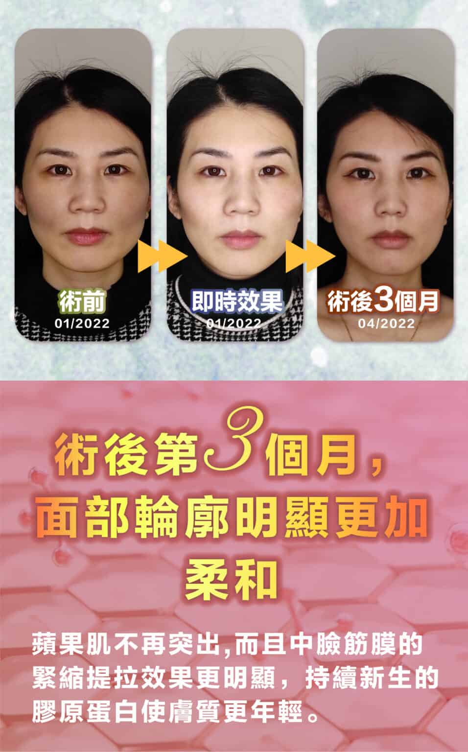 Thermage_new